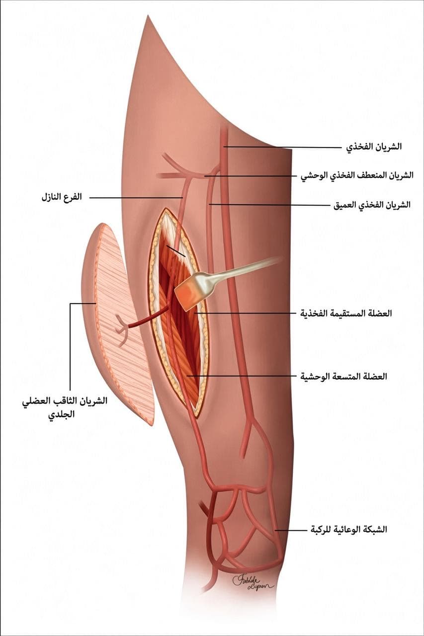 Fibula donor site closure