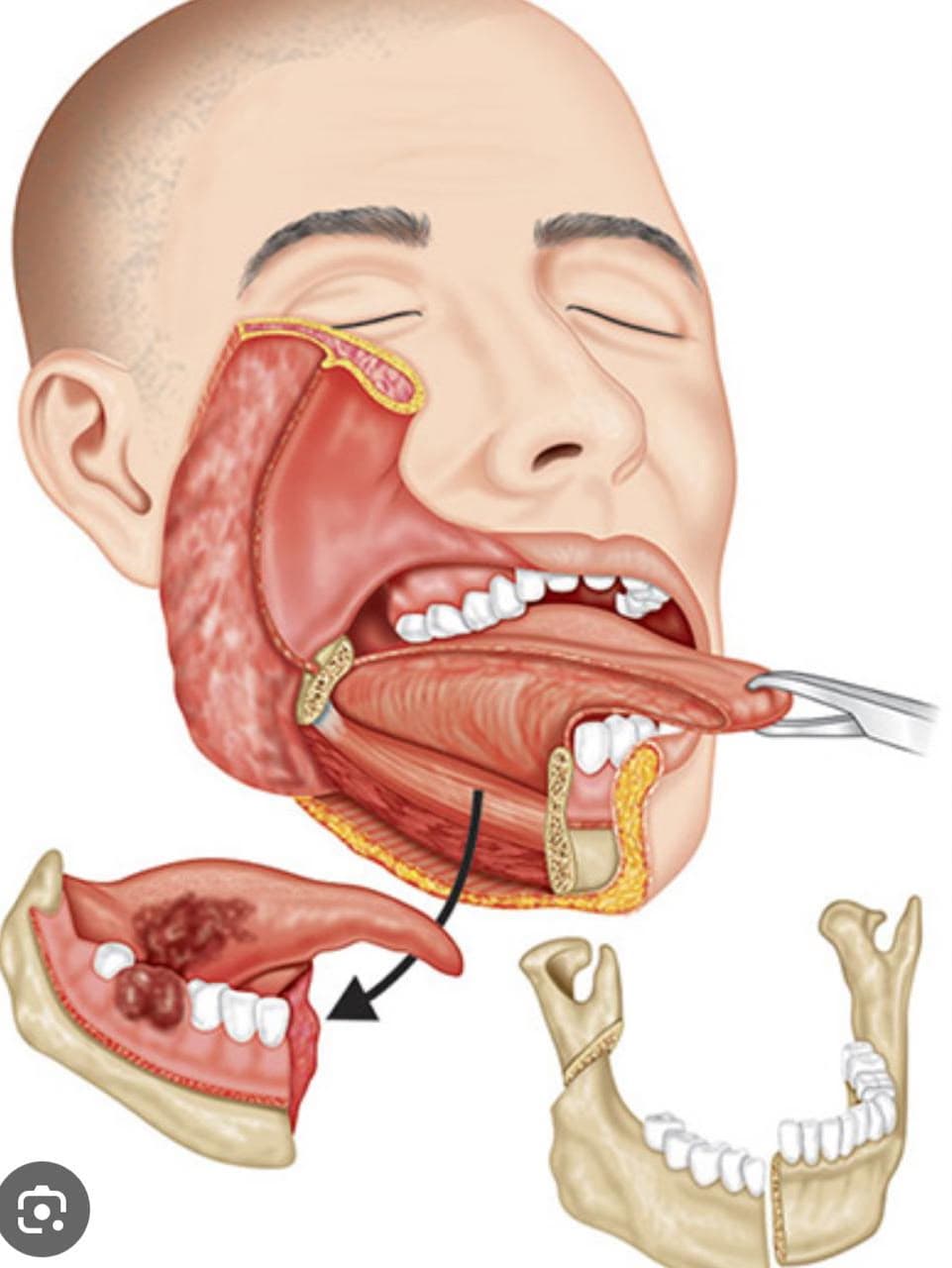 Surgical procedure